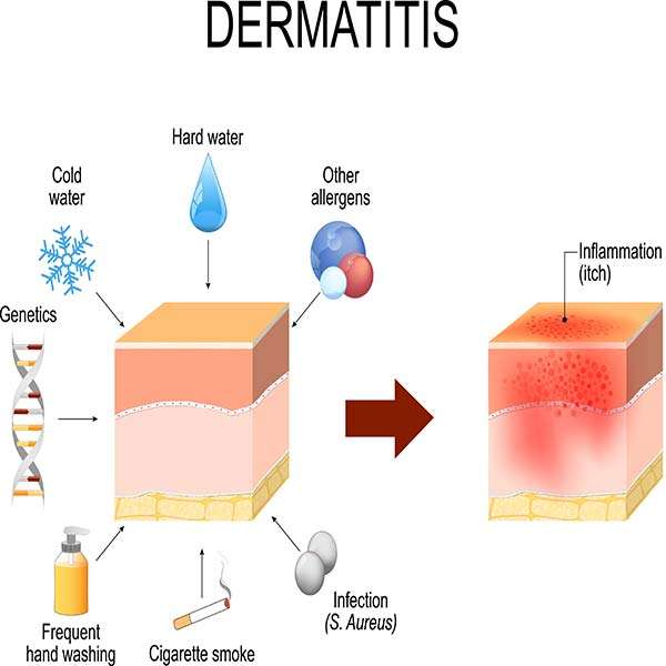 What-can-cause-Atopic-dermatitis or atopic-eczema